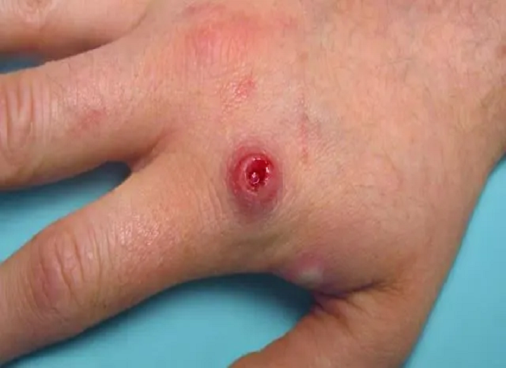 فهم monkeypox وكيفية منعه？